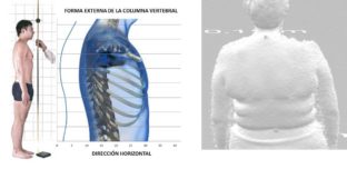 Toma de medidas antropométricas, registro de la forma externa de la columna vertebral y de la forma 3d de la espalda